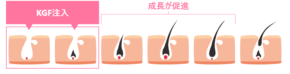 KGF(ケラチン生成細胞成長因子)の働き