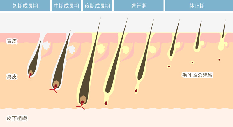 YAG脱毛（クールグライド）