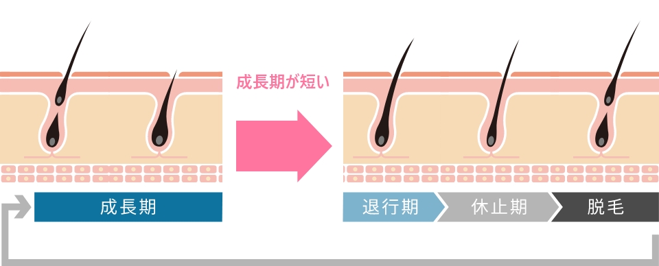 男性型脱毛症のヘアサイクル