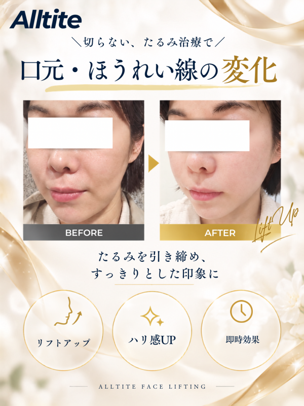 たるみ治療　オールタイト