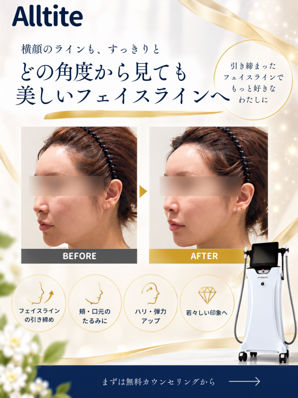 たるみ治療　オールタイト